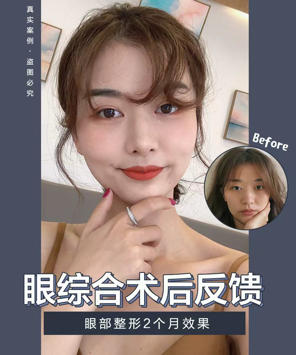 眼综合术后真实案例反馈（客户授权展示）